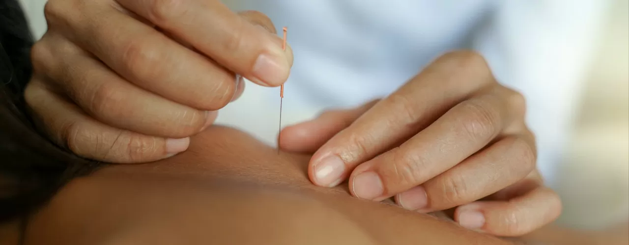 Dry-Needling-Triumph-Physical-Therapy-University-Place-WA